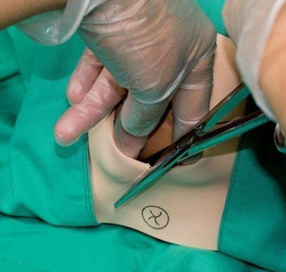 側切和撕裂哪個對身體傷害大 側切和撕裂會影響性生活嗎