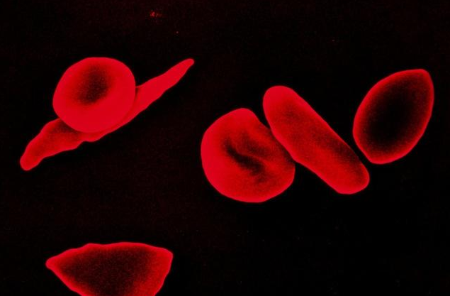 女性貧血危害大嗎 女性貧血的危害有哪些