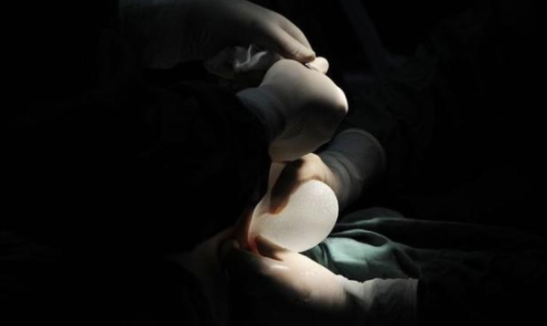 隆胸填充物引發(fā)癌癥召回是怎么回事 假體隆胸材料有哪些