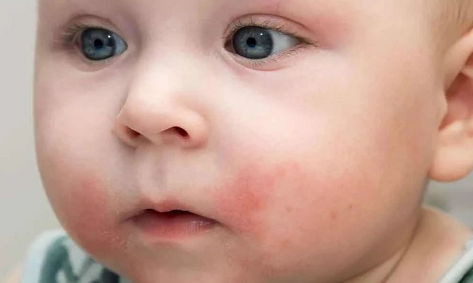 三伏天寶寶長痱子怎么應(yīng)對 寶寶長痱子了怎么好的快