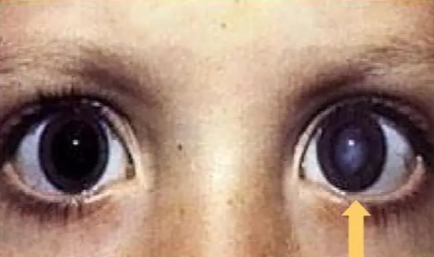 寶寶先天性淚囊炎是什么原因 寶寶先天性淚囊炎怎么造成的