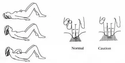 生完孩子后肚子還是很大是什么原因 生完孩子肚子大是不是腹直肌分離 生完孩子后肚子還是很大是什么原因 生完孩子肚子大是不是腹直肌分離