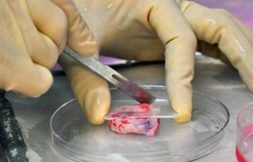 英國醫生發明卵巢移植法 卵巢移植有什么用