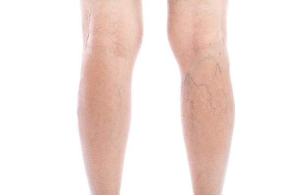 穿彈力襪對治療靜脈曲張有用嗎 孕婦有靜脈曲張如何治療