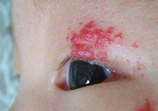 如何避免寶寶長胎記 寶寶長胎記是什么原因