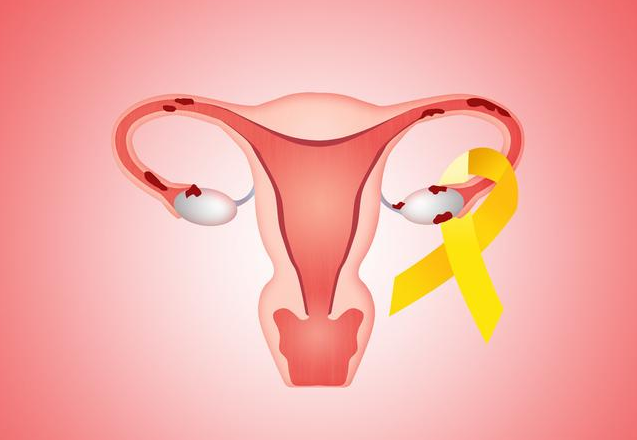 子宮內膜炎會引起不孕嗎，子宮內膜炎怎么護理好