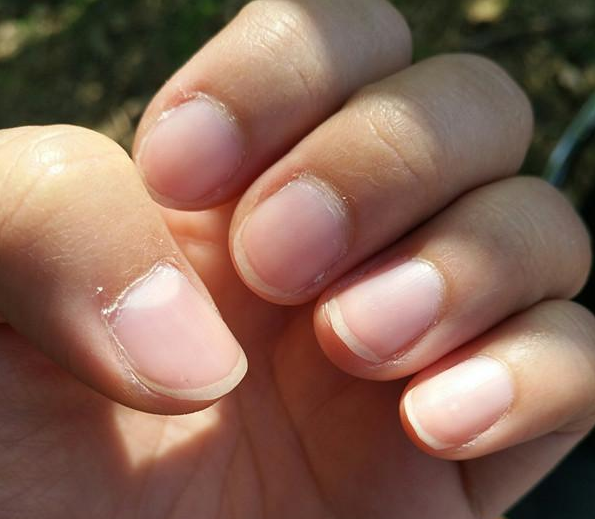 甲溝炎反復(fù)治不好是怎么回事 甲溝炎治療方法