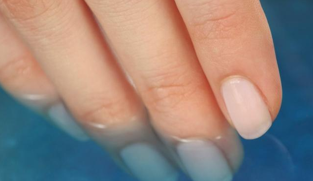 甲溝炎反復(fù)治不好是怎么回事 甲溝炎治療方法