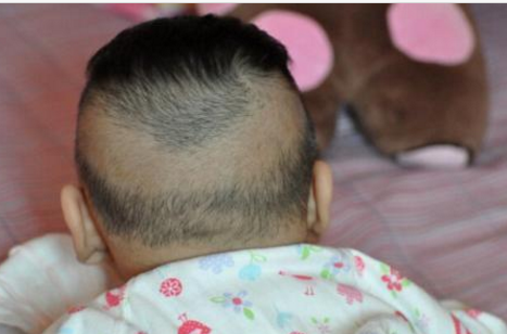 寶寶枕禿就是缺鈣嗎 寶寶枕禿是什么原因