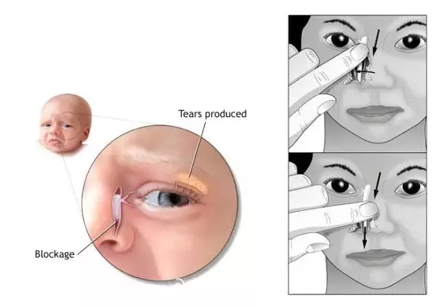 孩子的眼屎多正常嗎 孩子眼屎多是不是淚囊炎