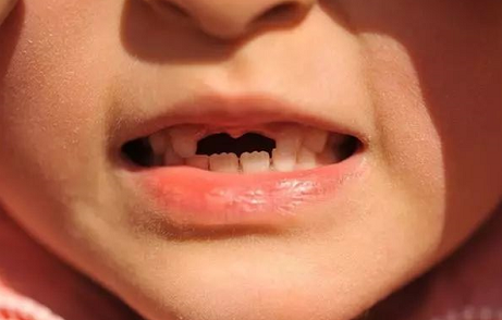 寶寶第一次掉牙的說說 小孩第一次掉牙怎么發朋友圈