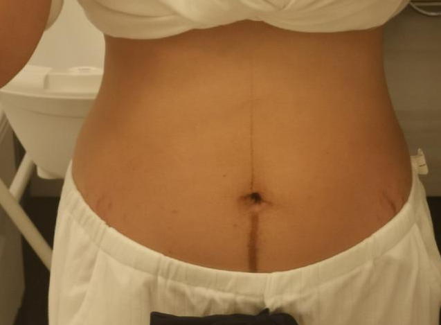 懷孕肚子上的黑線是怎么形成的 孕婦肚子上的黑線越黑是生男孩嗎