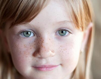 8歲的孩子長雀斑是什么原因 孩子長雀斑什么時候治療最好 8歲的孩子長雀斑是什么原因 孩子長雀斑什么時候治療最好
