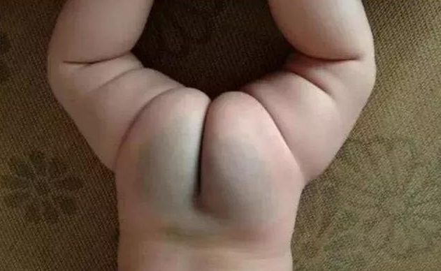 寶寶屁股上的淤青是什么 關于寶寶屁股上淤青的迷信說法