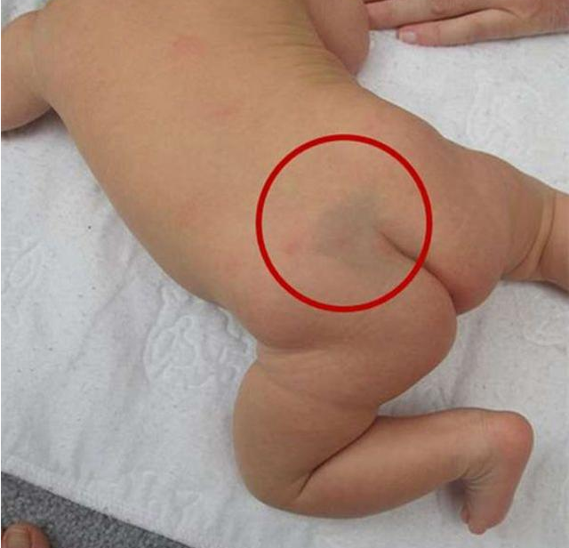 寶寶屁股上的淤青是什么 關于寶寶屁股上淤青的迷信說法