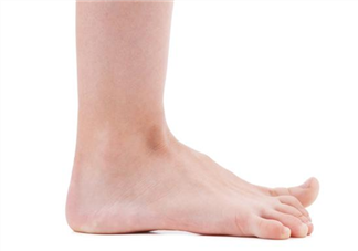 扁平足是遺傳還是后天形成的 判斷檢查扁平足的方法