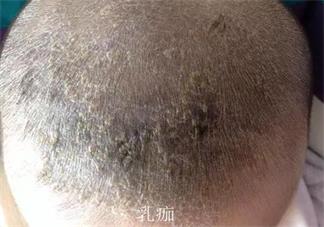 乳痂和濕疹有什么區別 乳痂和濕疹的圖片