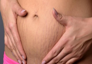 肚子長妊娠紋的4個信號 妊娠紋主要都長在什么地方