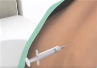 無痛分娩的原理是什么 生產什么時候可以打無痛