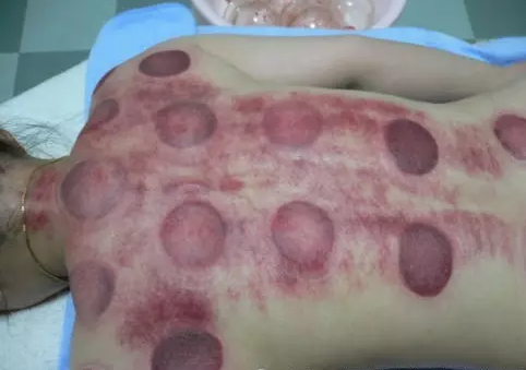 刮痧和拔罐哪個效果好 刮痧和拔罐有什么區別