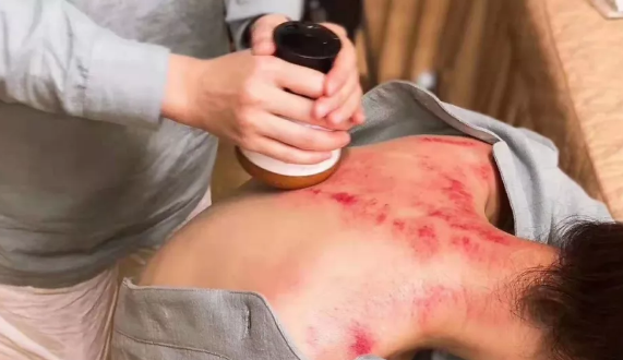 刮痧和拔罐哪個效果好 刮痧和拔罐有什么區別