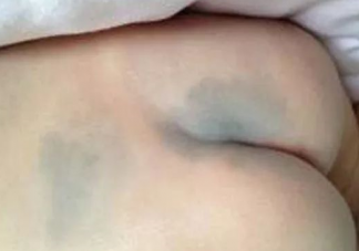 寶寶背上有青塊是怎么回事 寶寶身上的青塊多久能好