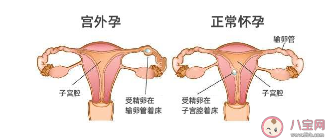 試管嬰兒能避免宮外孕嗎 試管嬰兒可能出現宮外孕的幾種情況