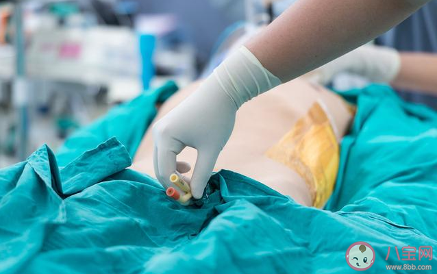 剖腹產什么時候能拔除導尿管 剖腹產拔導尿管后怎么上廁所