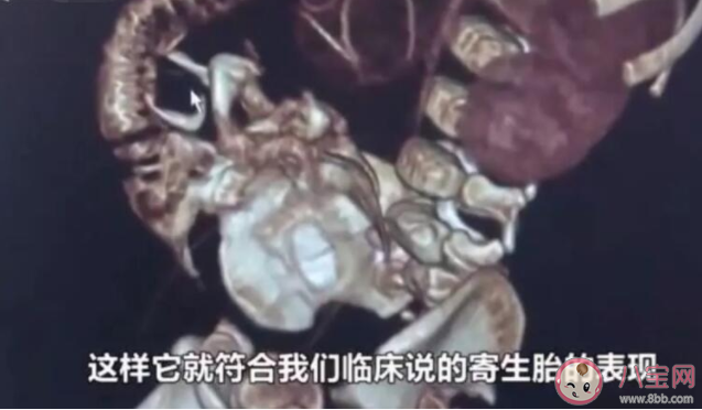 男嬰腹中藏寄生胎是怎么回事 寄生胎是怎么形成的