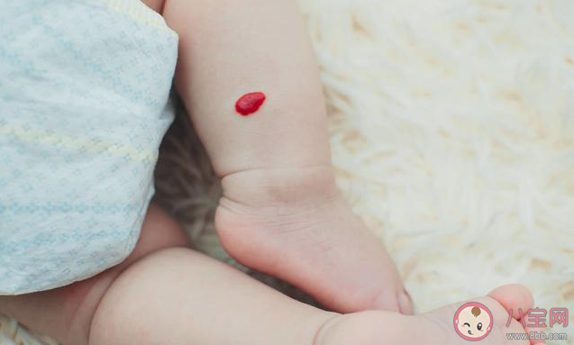 寶寶長胎記需要處理嗎 為什么寶寶會長胎記