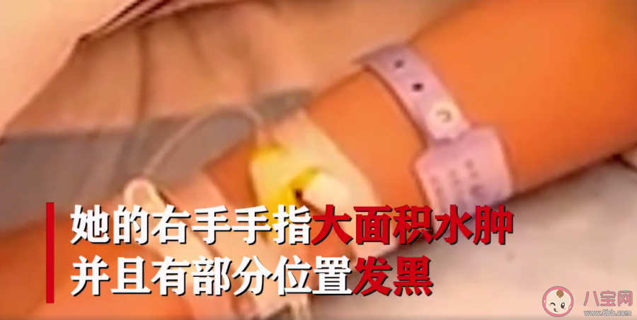 13歲女生學校掃雪3小時凍傷險遭截肢是怎么回事 冬天凍傷會有這么嚴重嗎