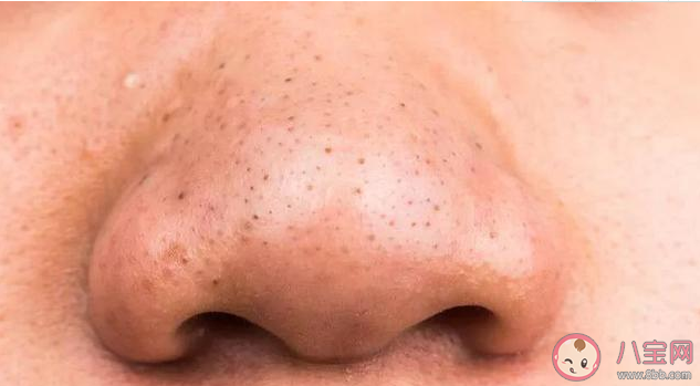 如何有效去除黑頭 錯誤去黑頭方法 如何有效去除黑頭 錯誤去黑頭方法