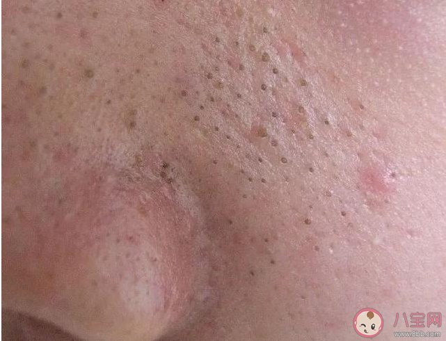 如何有效去除黑頭 錯誤去黑頭方法 如何有效去除黑頭 錯誤去黑頭方法