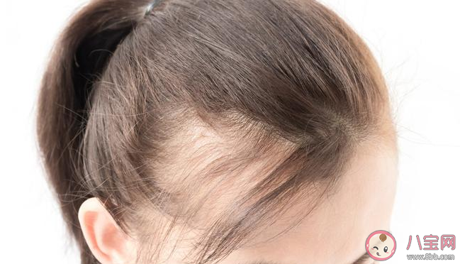 發(fā)際線高的女生有什么煩惱 導致發(fā)際線變高的原因