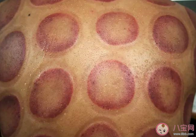 拔罐減肥要天天拔嗎 拔罐減肥飲食上要注意什么