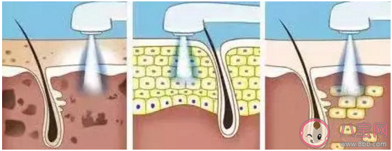 光子嫩膚的功效和作用是什么 光子嫩膚能維持多久 光子嫩膚的功效和作用是什么 光子嫩膚能維持多久