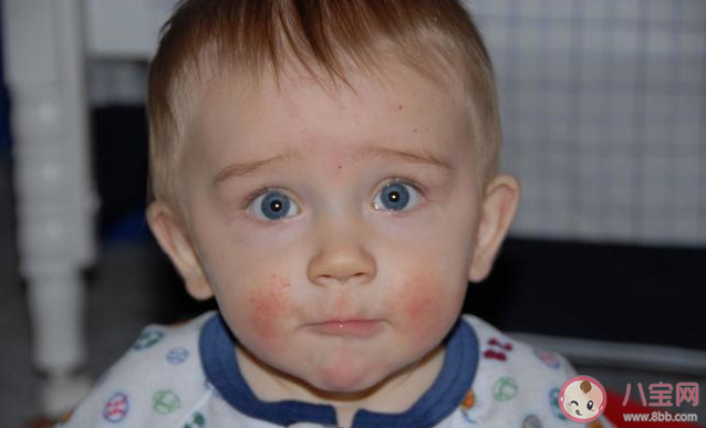 小孩發(fā)熱伴有皮疹是怎么回事 小孩發(fā)熱伴有皮疹可能是什么疾病