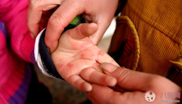 小孩發(fā)熱伴有皮疹是怎么回事 小孩發(fā)熱伴有皮疹可能是什么疾病