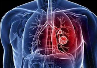 新型冠狀病毒感染了一定會發熱嗎 新型冠狀病毒前期的癥狀有哪些