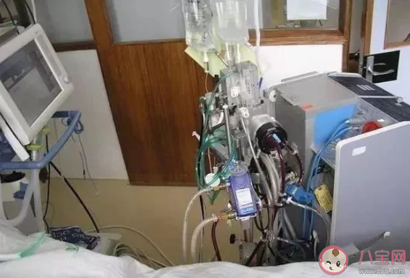 ecmo是什么樣子的 ecmo有什么用 ecmo是什么樣子的 ecmo有什么用