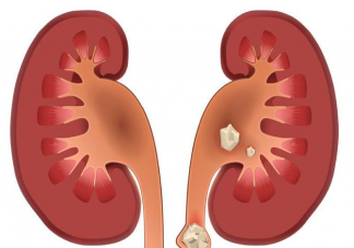 腎結(jié)石患者吃什么食物好 腎結(jié)石飲食要注意什么
