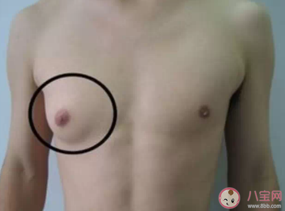 男性乳腺增生要緊嗎  男性乳腺增生能自愈嗎