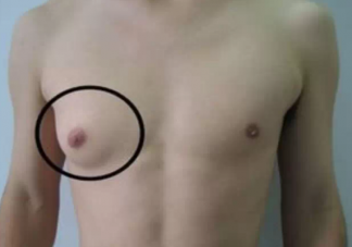 男性乳腺增生要緊嗎  男性乳腺增生能自愈嗎