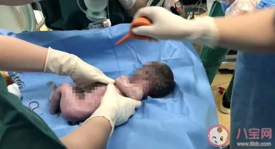 孕媽媽生產是助產士接生嗎  孕婦生產什么情況是醫生接生