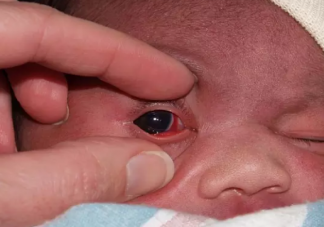 新生兒一個月還不睜眼是怎么回事  新生嬰兒一只眼不睜是怎么回事