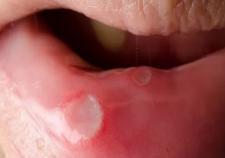 口腔潰瘍吃什么好  口腔潰瘍怎么辦