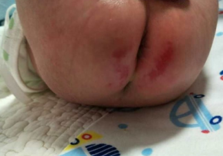 寶寶紅屁屁怎么樣能快些好  寶寶紅屁屁會哭鬧嗎