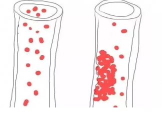 血脂稠是什么原因造成的  血脂稠吃什么食物好