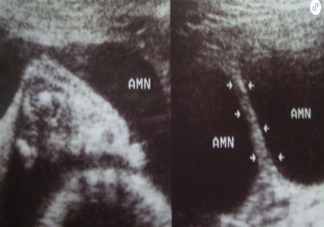 羊膜帶怎么成形  羊膜帶對寶寶有影響嗎