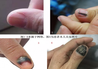 小孩指甲根發黑怎么回事  小孩指甲發黑什么